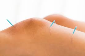 Knee-deep in Acupuncture for the Knees
