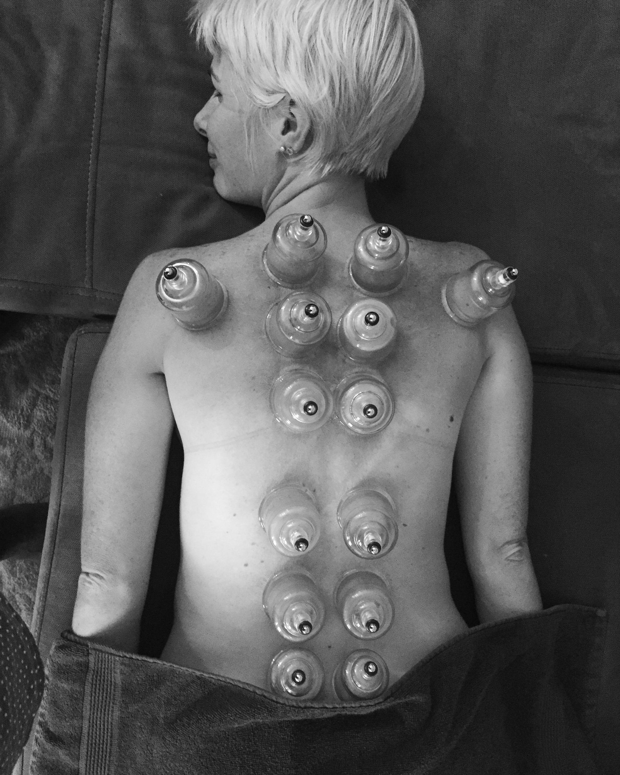 What Is Cupping?