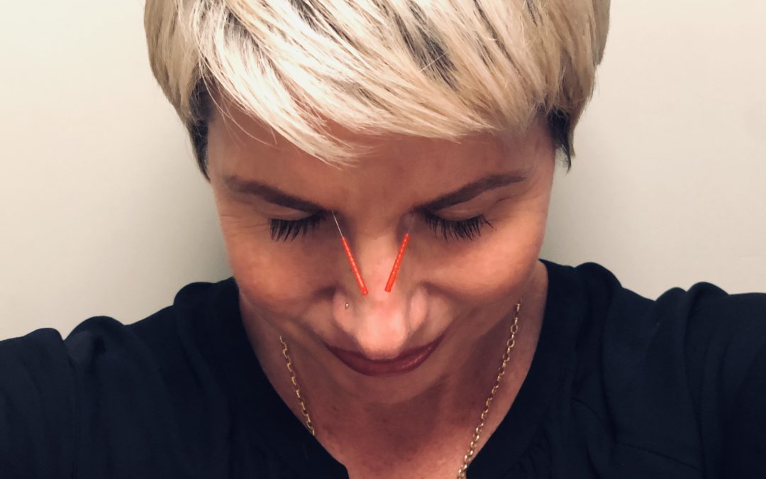 Acupuncture in Carroll Gardens, Brooklyn